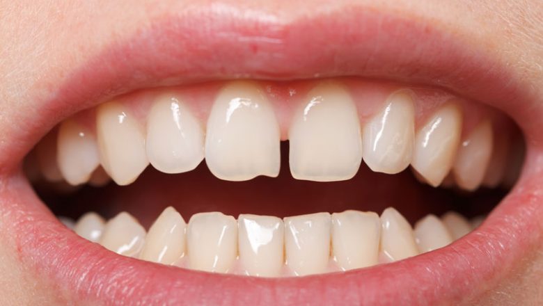 दाँतमा आउने समस्याको घरमै उपचार, हेर्नुहोस यस्ता छन् उपाय